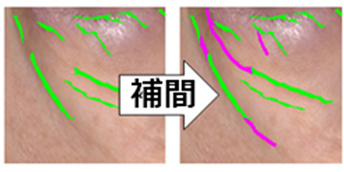 画像：美容皮膚科の目視をデジタル化（例：しわ）